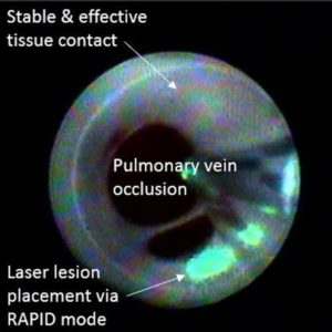 direct visualization of pulmonary vein isolation